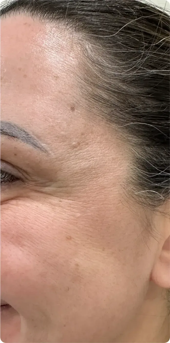 After: Botox: crow's feet, side view