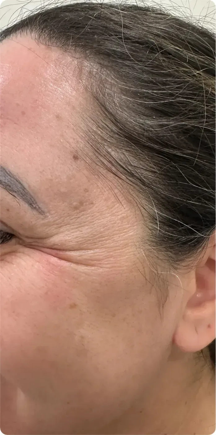 Before: Botox: crow's feet, side view