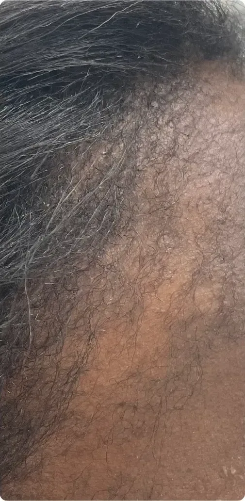 After: PRP hair treatment: hairline, side view