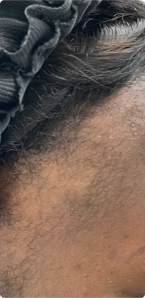 Before: PRP hair treatment: hairline, side view