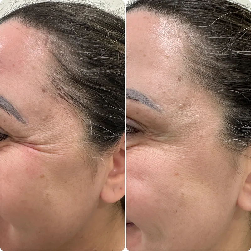 Botox before and after: crow's feet, side view