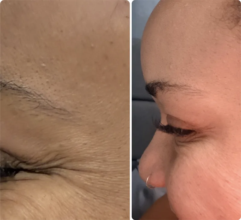 Botox before and after: crow's feet when smiling