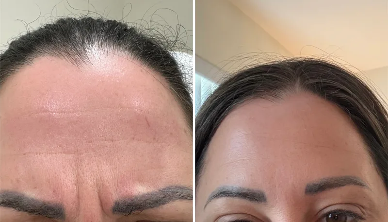 Botox before and after: frown lines between the brows