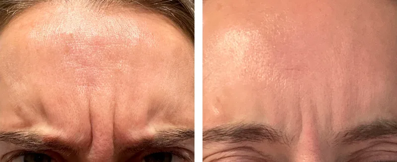 Botox before and after: frown lines between the brows, close-up