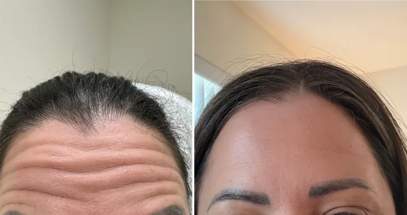 Botox before and after: forehead lines