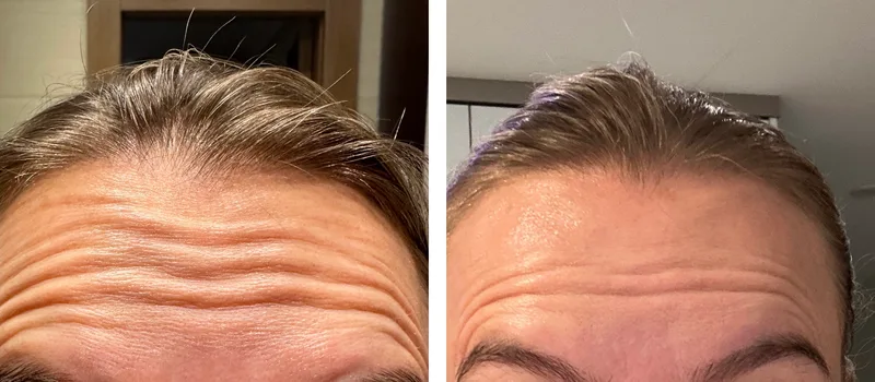 Botox before and after: forehead lines with raised brows