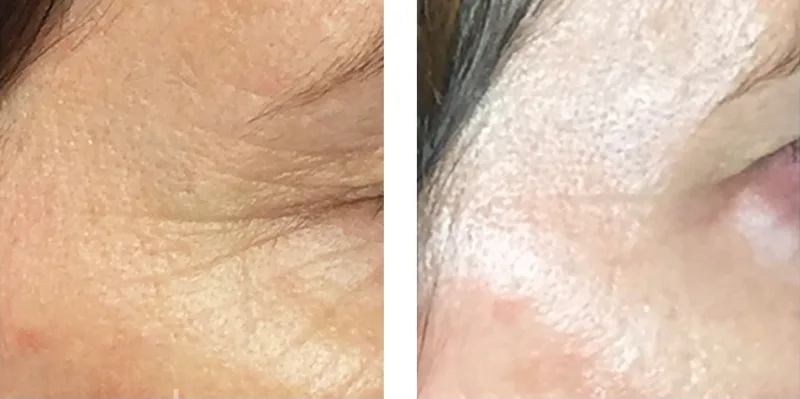 Botox before and after: lines at the outer corner of the eye
