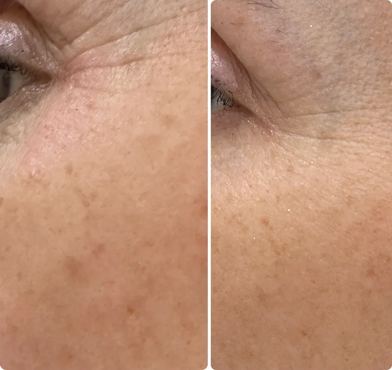 Botox before and after: fine lines around the eye