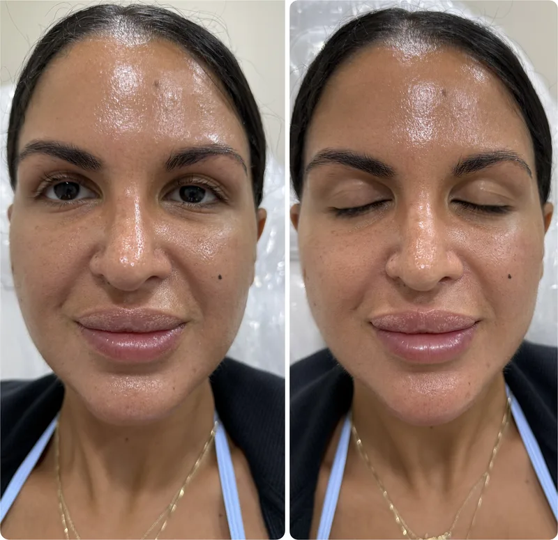 Lip filler before and after, front view