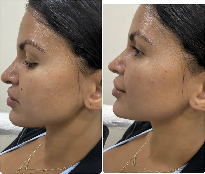 Filler before and after: chin and jawline, left profile