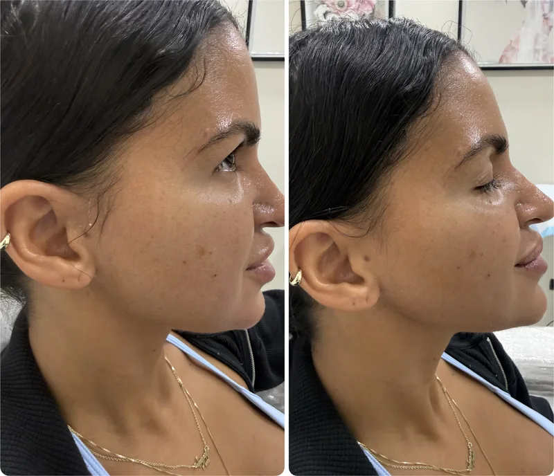 Filler before and after: chin and jawline, right profile