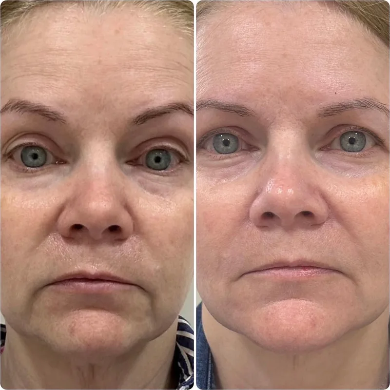 Filler before and after: full face, front view