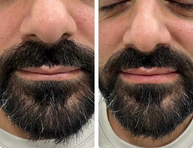 Lip filler before and after
