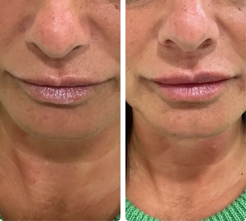 Lip filler before and after, close-up
