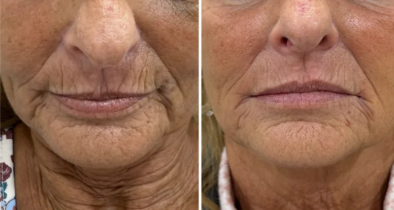 Filler before and after: lines around the mouth