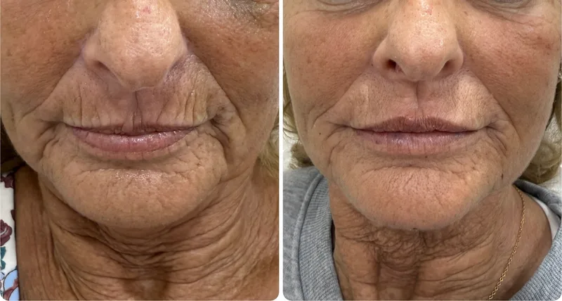 Filler before and after: lines around the mouth, second view