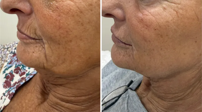 Filler before and after: jawline and lower face, side view