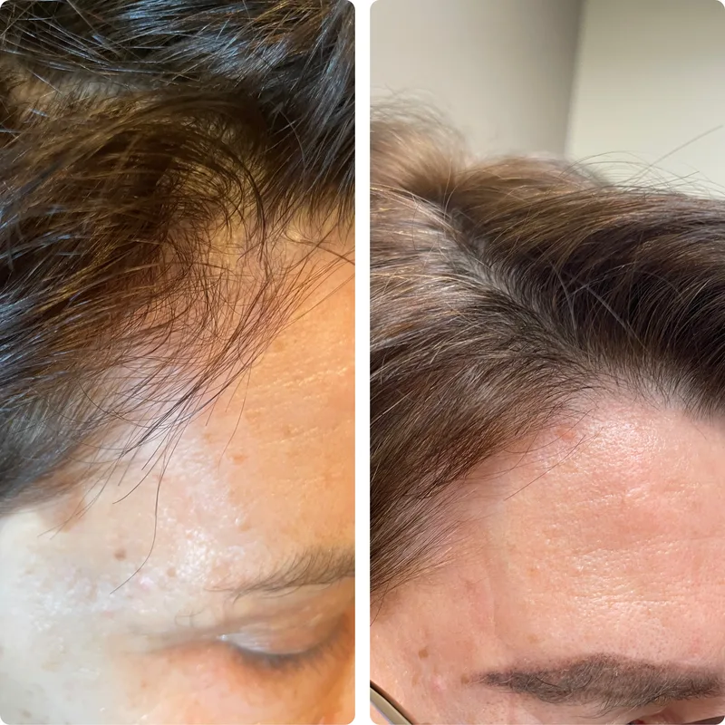 PRP hair treatment before and after: front hairline