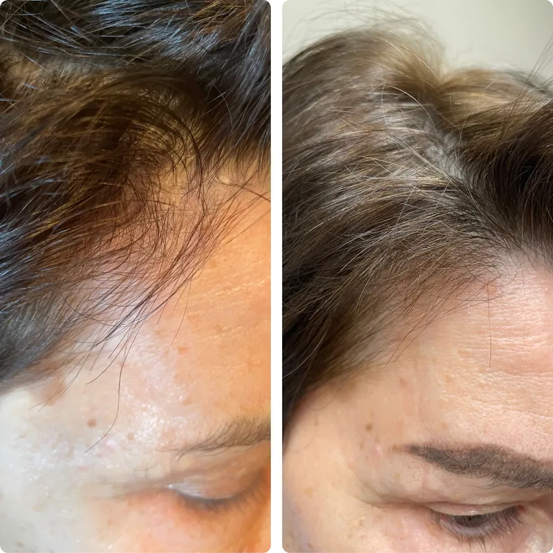 PRP hair treatment before and after: front hairline, later result