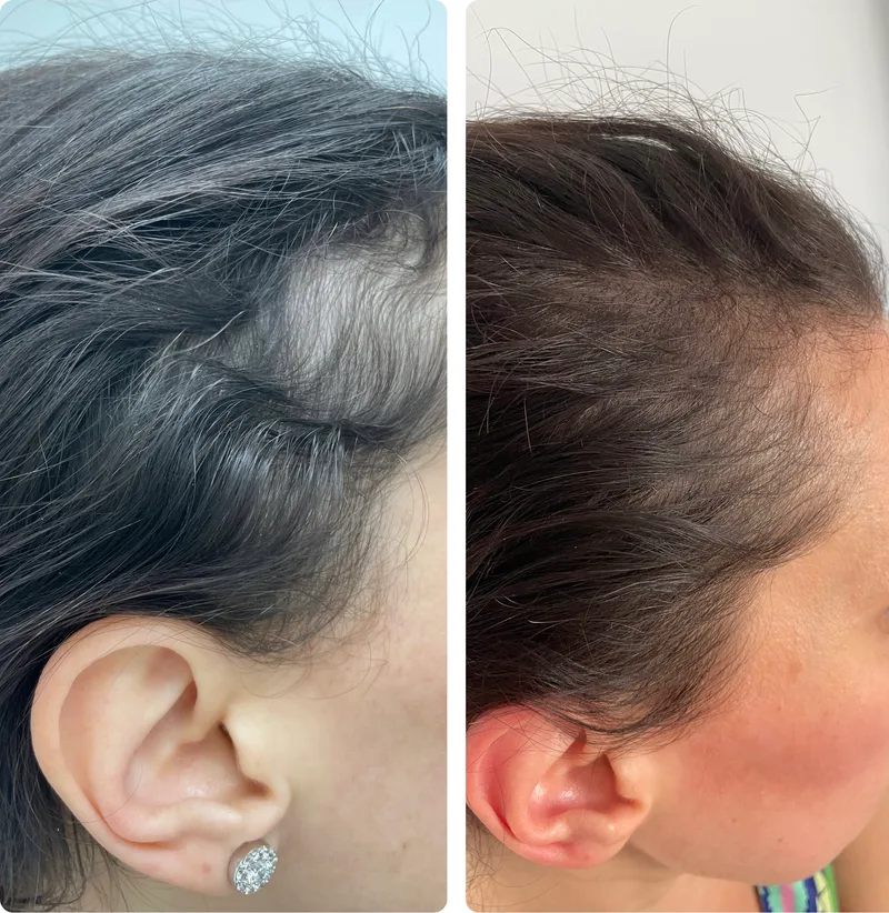 PRP hair treatment before and after: temple
