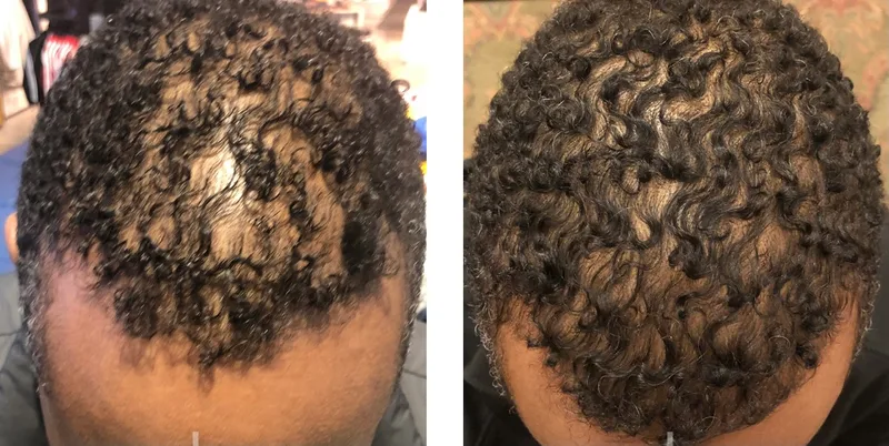 PRP hair treatment before and after: crown, top view