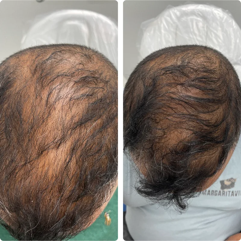 PRP hair treatment before and after: crown, top view