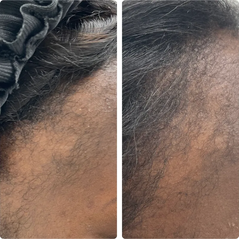 PRP hair treatment before and after: hairline, side view